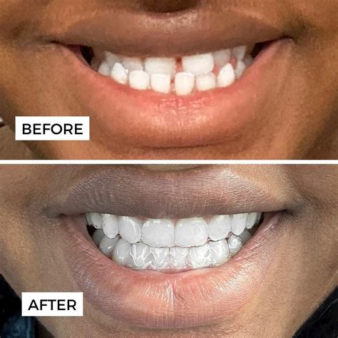 Before and After Invisalign®️ Treatment .